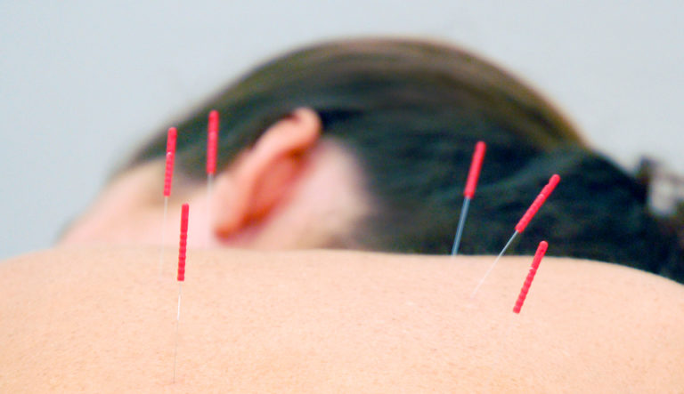 Acupuncture patient